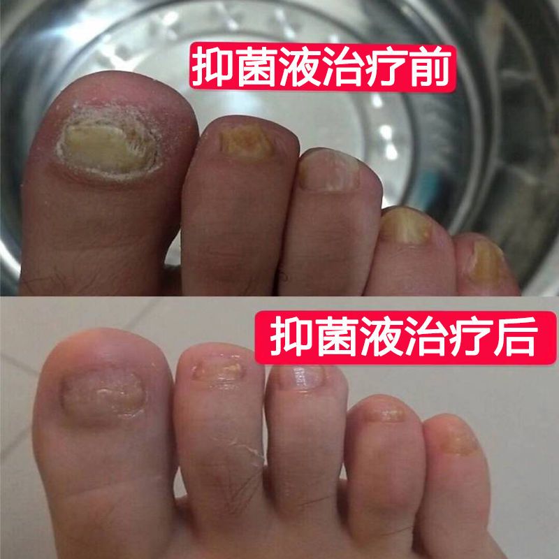 针对各类严重灰指甲灰甲克星去除顽固厚甲增甲软甲修复抑菌液