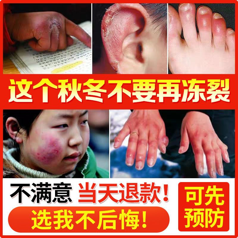 冻疮膏防冻膏防裂膏抑菌止痒修护草本冻疮膏皲裂膏手足脸耳可用