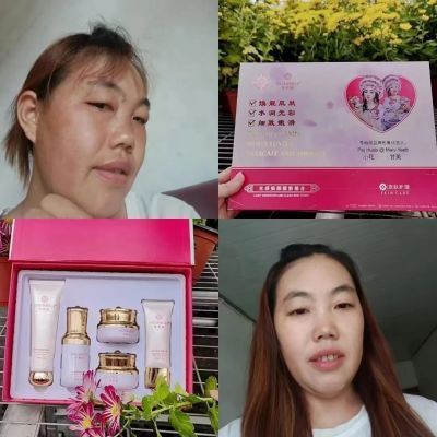 苗族雪柏丽美白祛斑斑点皮肤暗黄五件套老款的15到25天就看出效果