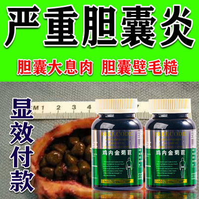 胆囊炎药胆囊息肉药胆囊壁毛糙胆囊炎专用药胆管炎后背痛口苦尿黄