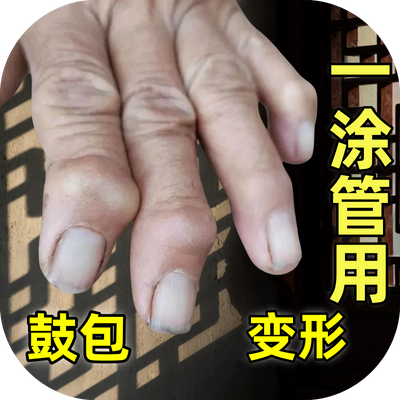 手指关节肿大变形手指骨节粗大关节疼痛关节疙瘩鼓包风湿弯曲困难