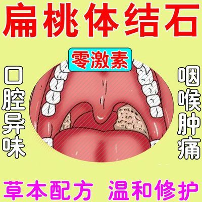 扁桃体结石【正品】扁桃体发焱咽喉疼痛有异物感口腔异味白点清理