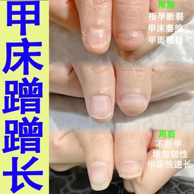 指甲快速生长液养甲损伤修复增长液薄软增厚防断甲面萎缩修护液