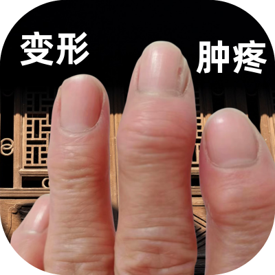 手指骨节粗大变形手指关节疙瘩鼓包手指肿大消肿止痛手指疼痛专用