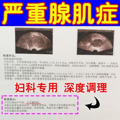 【保密发货】腺肌症宫寒痛经内膜异位经量大月经不调肚子疼有异味