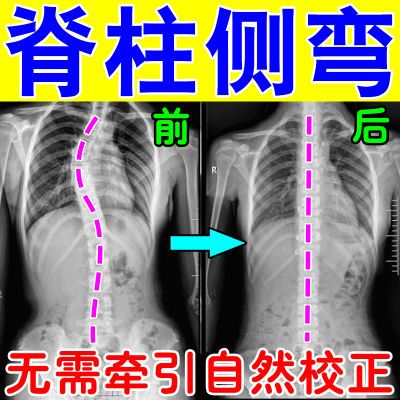 【自然矫正】脊柱侧弯改善高低肩剃刀背脊柱侧凸弯曲变形含胸驼背