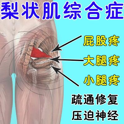 梨状肌综合症屁股疼下肢疼大小腿外侧放射性疼痛麻木坐骨神经痛贴