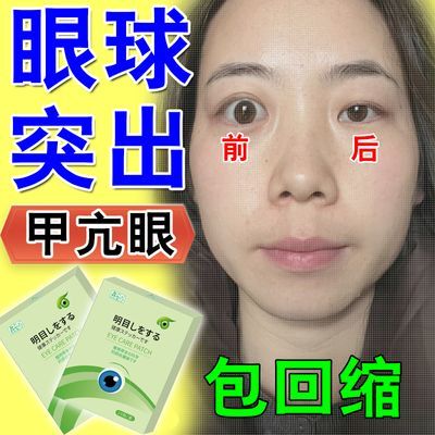 回缩快】眼球突出甲亢眼凸青蛙眼眶缩小活动受限异物感眼肿凸眼贴