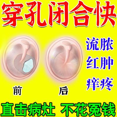 【耳膜修复】耳膜穿孔听力下降鼓膜破裂修复中耳炎流脓修复特效液