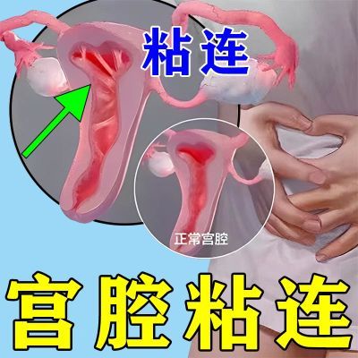 宫腔粘连分离贴【调宫贴】子宫内膜薄修复宫寒月经不调小腹坠疼r