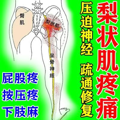 梨状肌疼痛坐骨神经痛屁股疼腰疼压迫神经大小腿外侧放射疼痛麻木