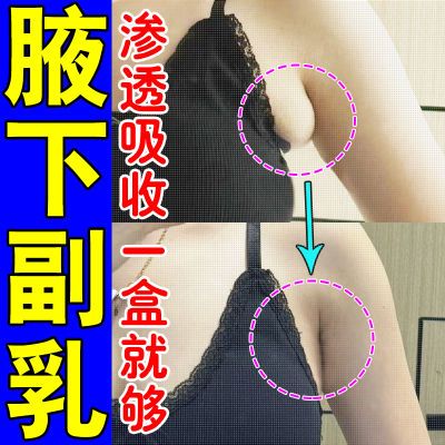 【露出自信】副乳肖除神器腋下淋巴堵塞肿大胀痛硬块鼓包赘肉通用