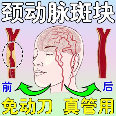 免动刀】颈动脉斑块堵塞导致脑供血不足头昏头晕肢体麻木疏通喷剂