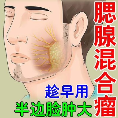 腮腺混合瘤【新疗法】腮帮子肿大发炎耳后硬块结节腮腺囊肿痄腮贴