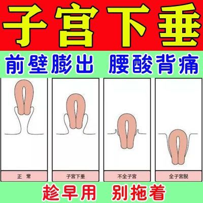 【正品】子宫下垂腰腹酸痛前壁膨出白带异常憋不住尿小腹坠痛专用