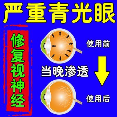 免去激光】青光眼降眼压眼胀眼痛视线模糊视野缺陷白内障干涩怕光