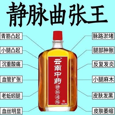 云南中药正【静脉曲张】油曲张专用药蚯蚓腿青筋凸起小腿肿红血丝