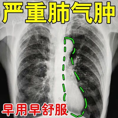 肺气肿专用贴咳嗽痰多胸闷气短呼吸困难上不来气止咳平喘穴位贴S