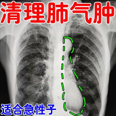 【建议一盒】严重肺气肿专用咳嗽痰多胸痛胸闷呼吸困难上不来气r