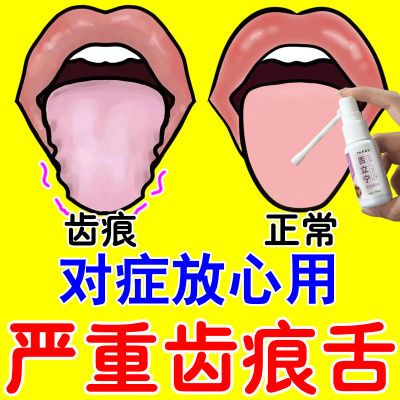 严重齿痕舌【恢覆如初】舌炎裂纹舌灼热麻木疼痛舌苔白厚口干口臭