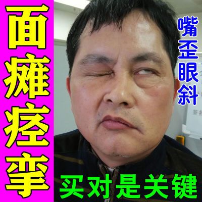 面瘫贴面神经麻痹后遗症口眼歪斜面部肌肉僵硬麻木流口水牵正贴y