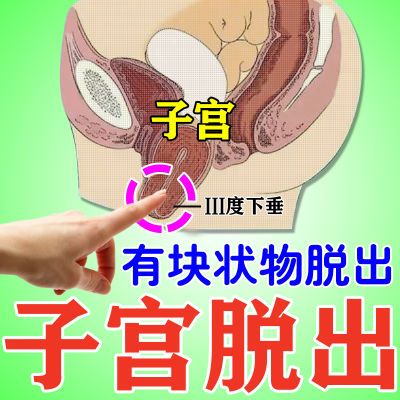 子宫脱出中老年人子宫脱落前壁后壁膨出肿物脱落腰骶酸痛憋不住尿