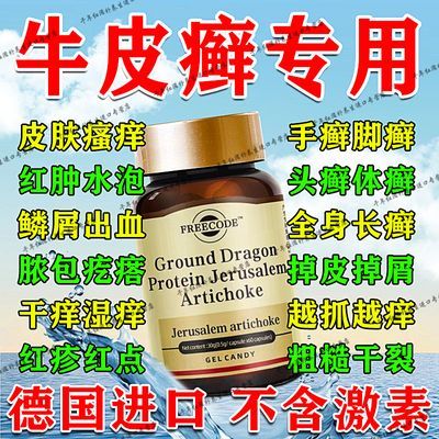 多年牛皮癣】红肿出血皮肤瘙痒鳞屑头癣手癣脚癣正品德国进口胶囊