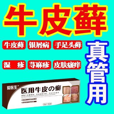 牛皮癣【医用级】银屑病头皮癣湿疹手足癣体癣瘙痒止痒膏