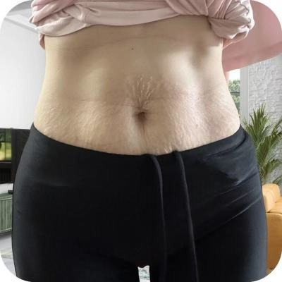 去妊娠纹产后修复霜淡化提拉紧致肚皮预防祛除肥胖纹生长纹去疤膏