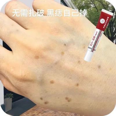 【正品点痣膏】点痣膏无痕脸部无痛强效祛黑痣肉痣痦子儿童神器