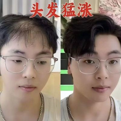香港专研喷雾头发生发快速发生生长增发发护发防脱秃顶免洗男女
