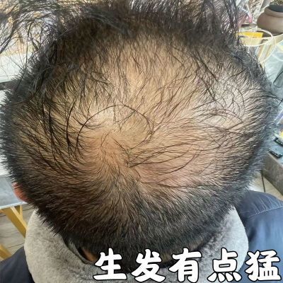 【生发神器】头发快速生长增发液快速增长防脱密发洗发不掉发