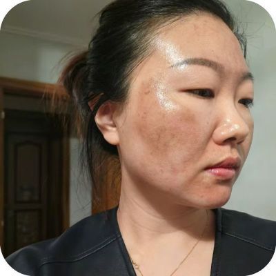 正品祛斑霜黄褐斑老年斑晒斑雀斑色素斑妊娠斑遗传斑顽固斑