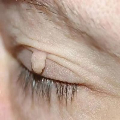 【专祛小肉粒】身上肉粒脖子脸部头部腋下手脚温和草本外用去肉粒