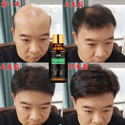 头发生长液生发液快速变长增发密发秃顶脂溢性快速生长防脱育发液