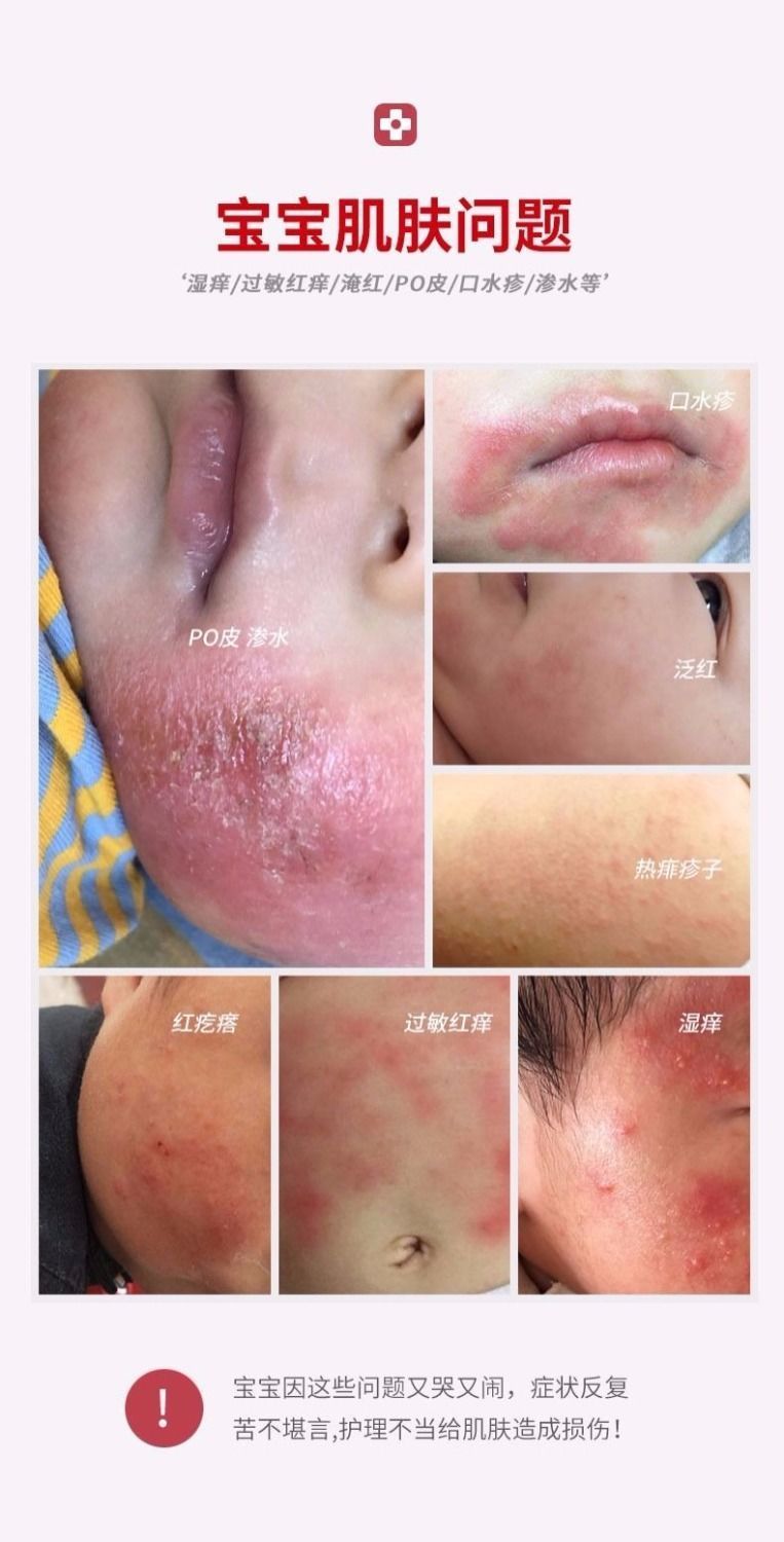 什么虫咬了会反复起疹子 dc0fa8a3-3aef-405d-83bc-8561b3b2ac7c.jpg.a.jpeg