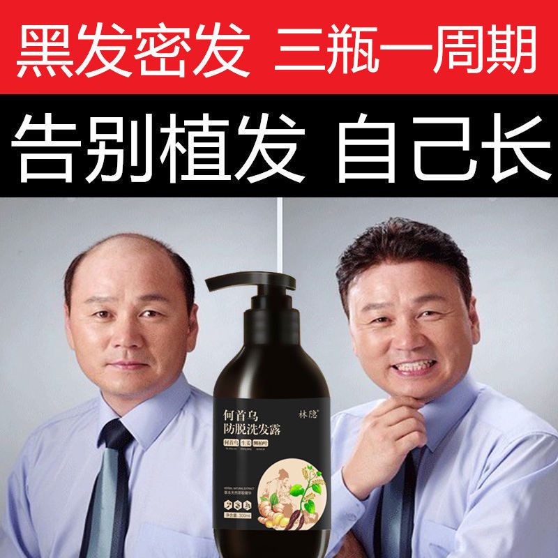 【真实生发案例】防脱生姜生发洗发水增发密发液控油去屑止痒露