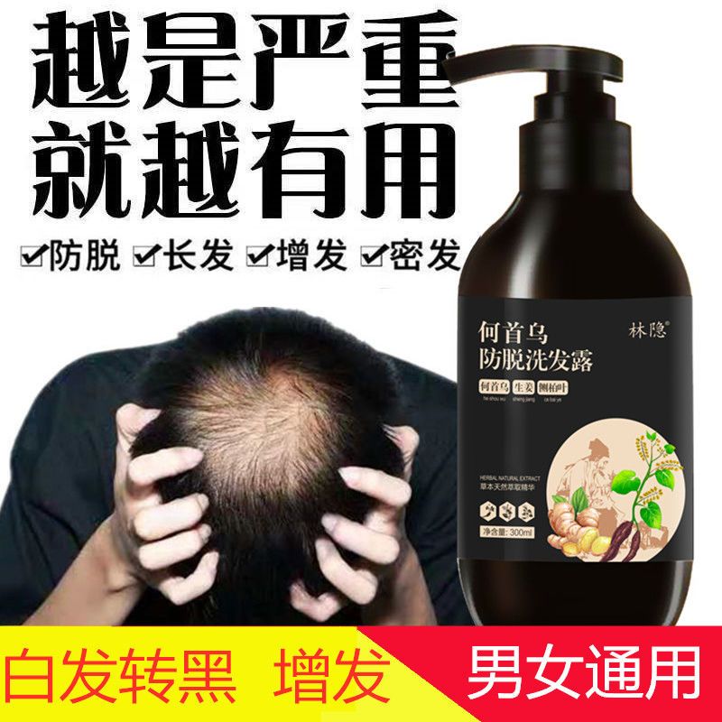 【真实生发案例】防脱生姜生发洗发水增发密发液控油去屑止痒露