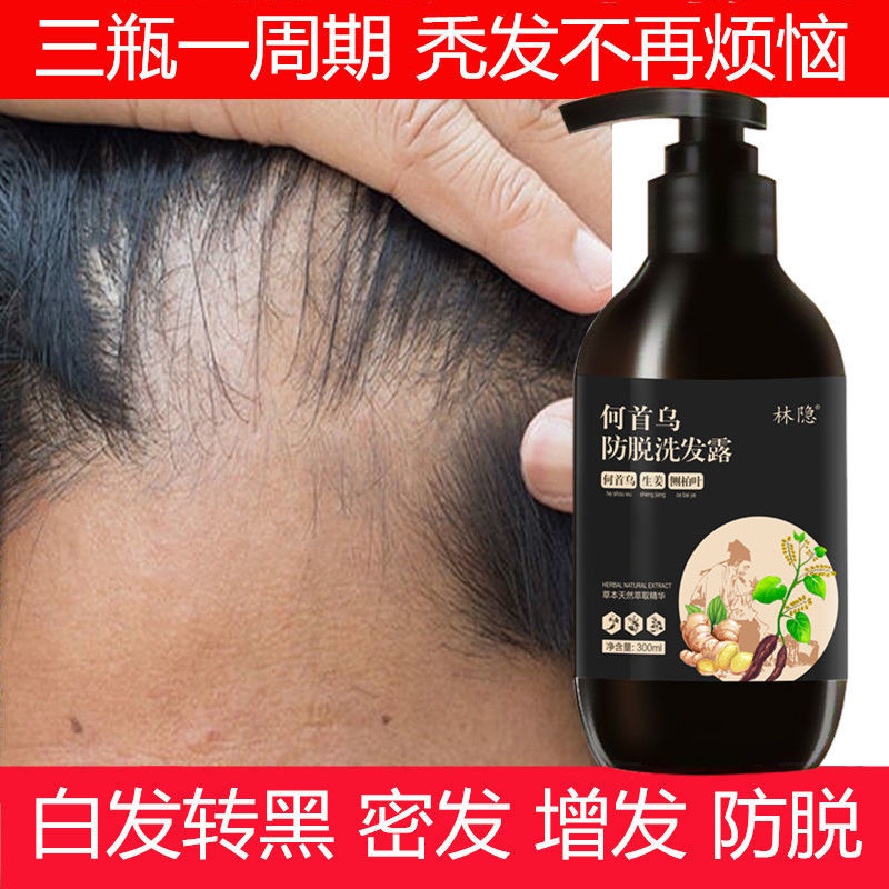 【真实生发案例】防脱生姜生发洗发水增发密发液控油去屑止痒露