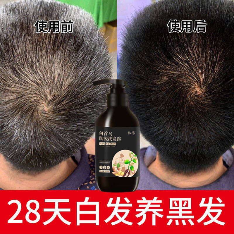 【真实生发案例】防脱生姜生发洗发水增发密发液控油去屑止痒露