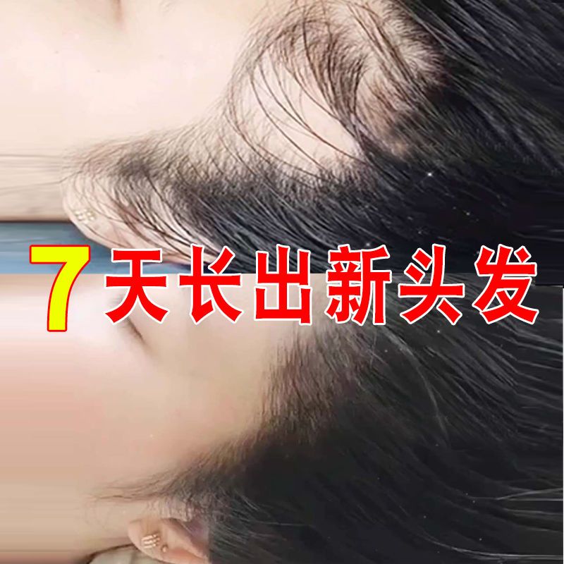 【最快7天】生发剂增发密发防脱发生发液快速变长养发固发神器