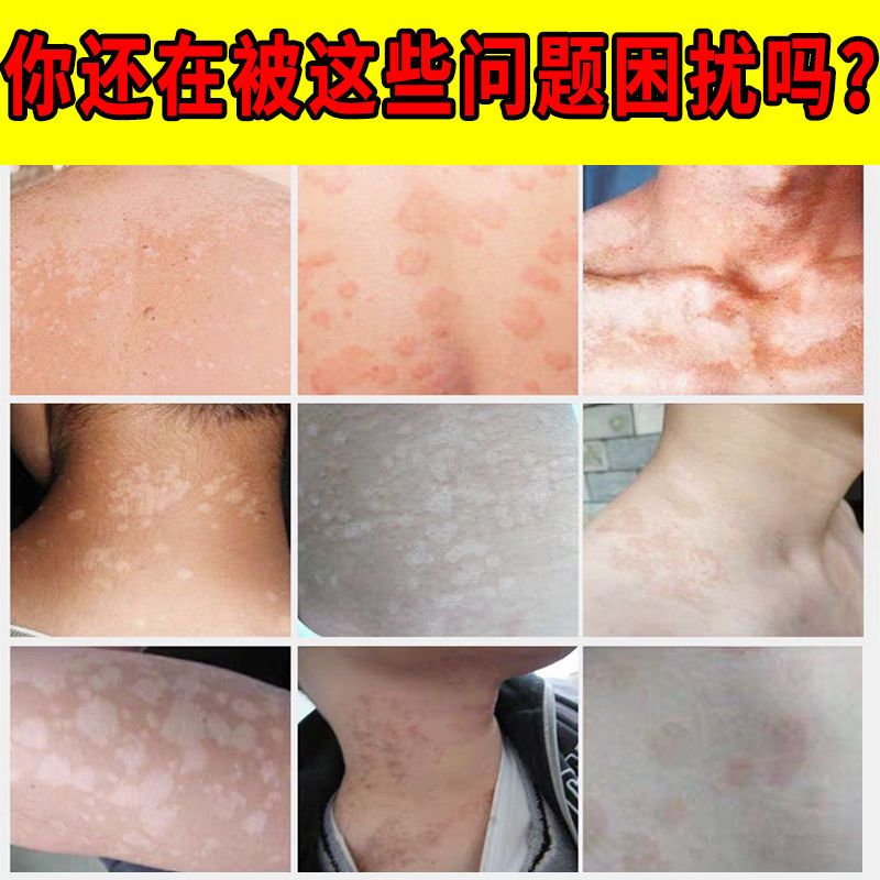 3天可消 去汗斑花斑点状斑片状瘙痒汗斑净胸前背部褐色红白色 虎窝拼