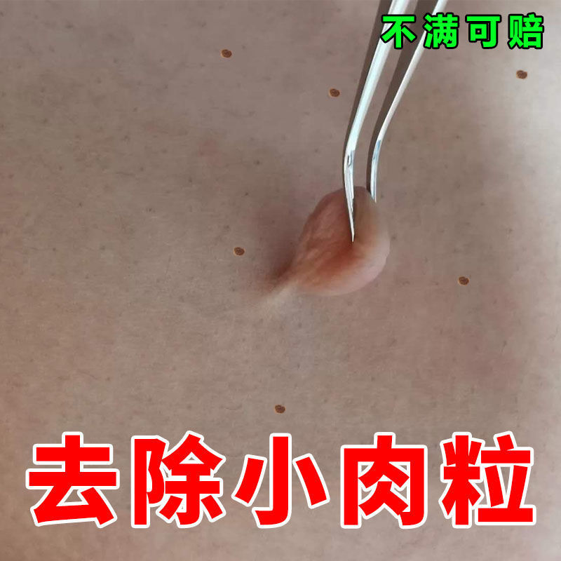 【不满可赔】去除脖子小肉粒颈部赘皮赘草温和不留疤 祛丝状尤