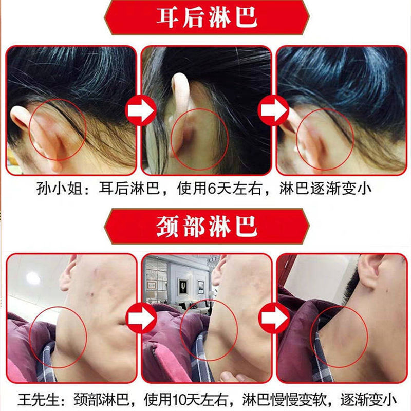 最快三天 淋巴结散结膏淋巴肿大炎消贴颈部耳后腋下淋巴结发炎 德济康健堂 最快三天 淋巴结散结膏淋巴肿大炎消贴颈部耳后腋下淋巴结发炎 德济康健堂