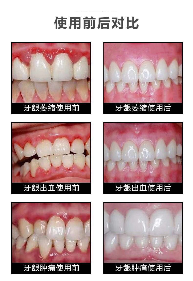 同.仁堂牙龈修护牙膏牙龈萎缩牙齿松动牙龈出血牙缝宽酸痛牙膏