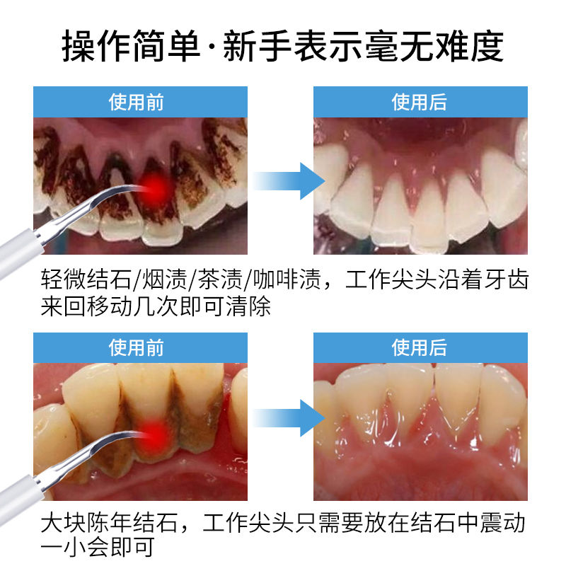 洗牙儀超聲波牙結石去除器去黃牙垢口臭牙漬神器電動牙刷衝潔牙器