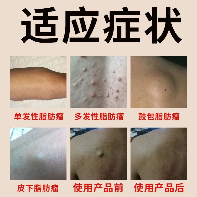 去单发性多发性脂肪瘤除皮下脂肪硬块凸起纤维粉瘤不去医院不开刀 虎窝拼