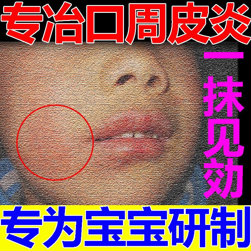 【不在復发】口周皮炎乳膏嘴巴周起皮鼻翼红斑嘴唇发痒癜痤疮乳膏