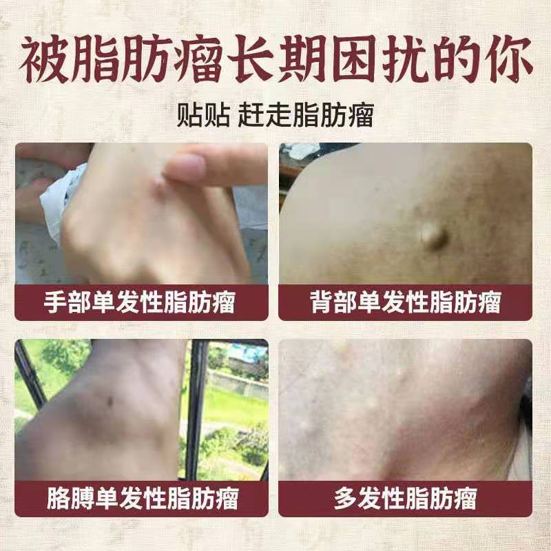 一夜不见 脂肪瘤消贴皮下粉瘤纤维硬块浅表多发性皮肤肿大专用 虎窝拼