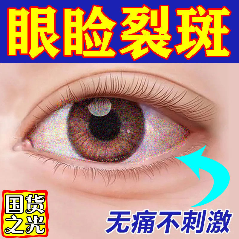 【国货之光】睑裂斑眼睛胬肉翼状胬肉眼睛发红肉疙瘩发干异物感